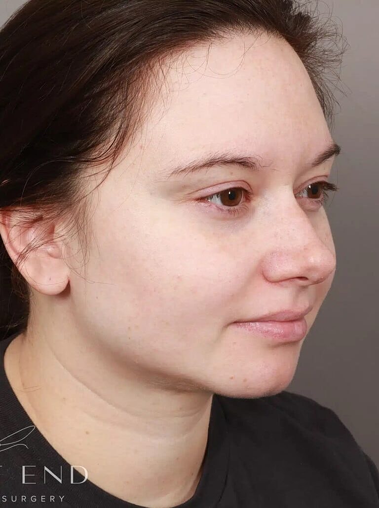 Face Liposuction Before & After