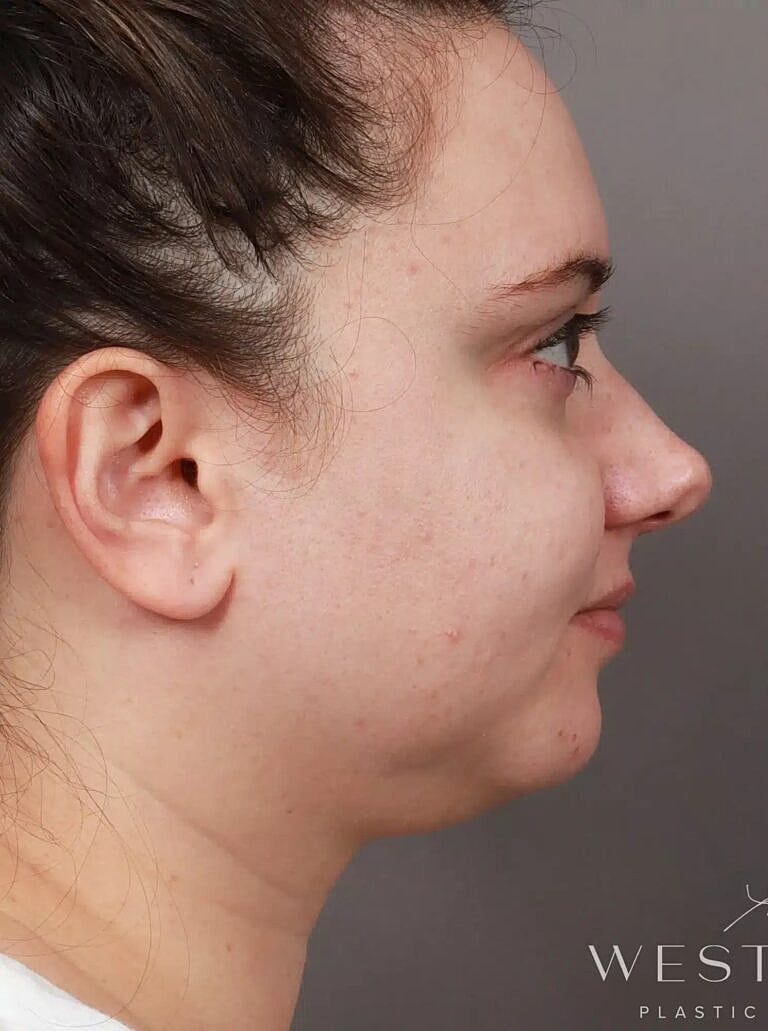Face Liposuction Before & After