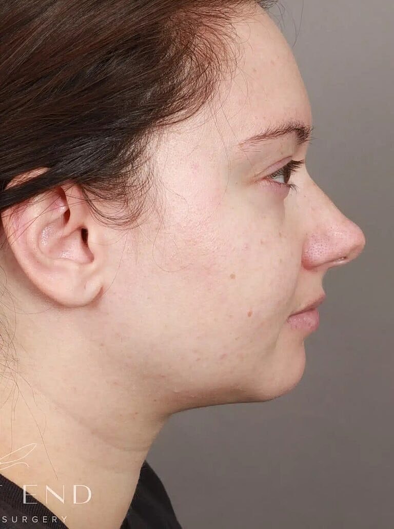 Face Liposuction Before & After