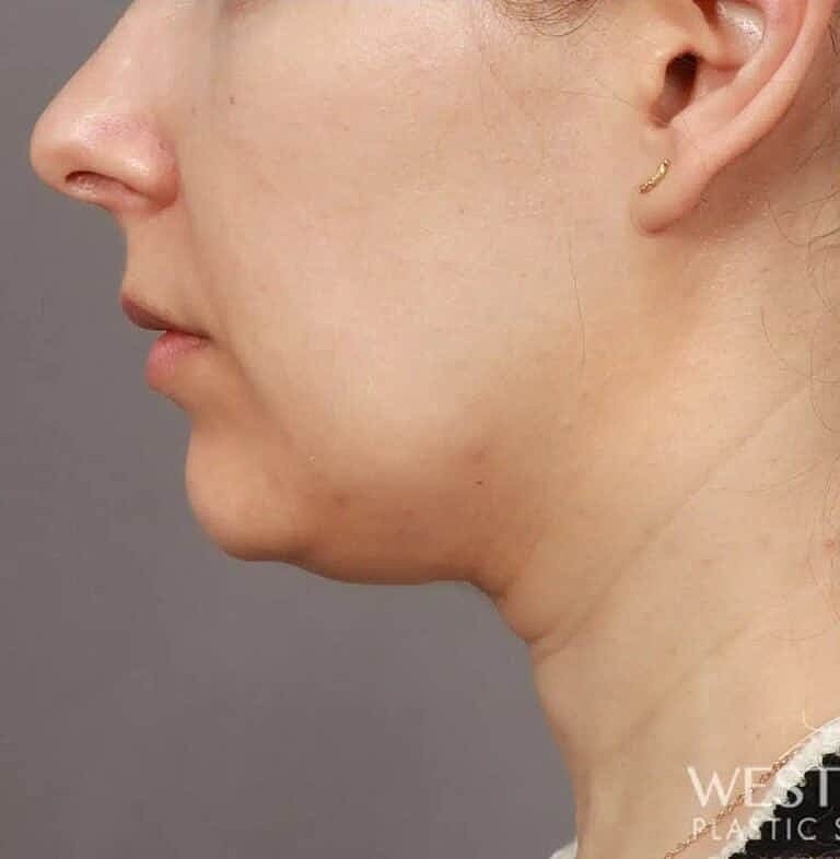 Face Liposuction Before & After