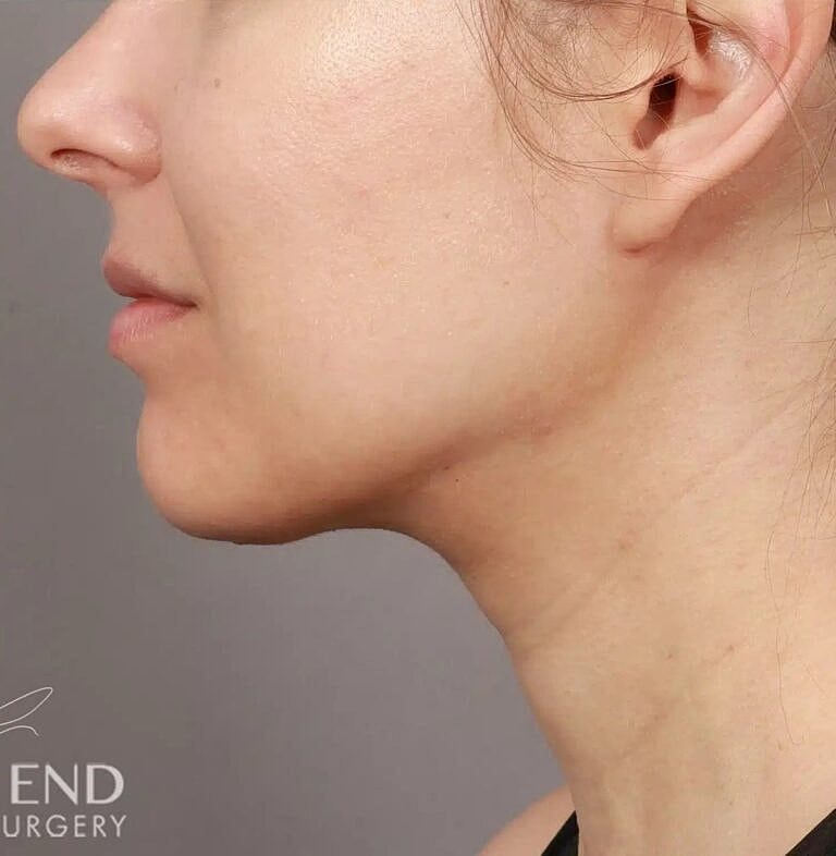 Face Liposuction Before & After