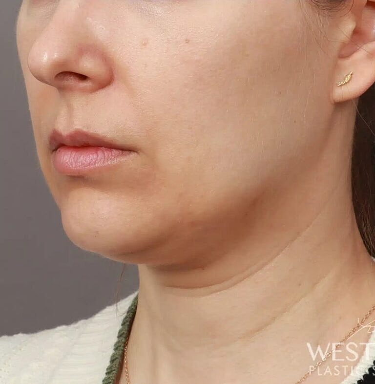 Face Liposuction Before & After