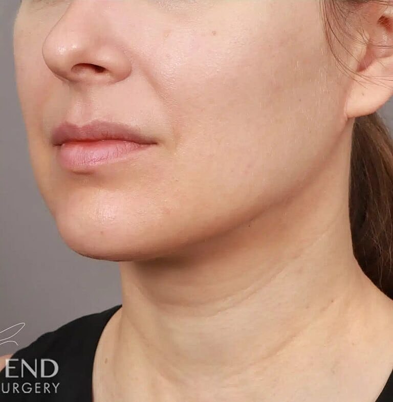 Face Liposuction Before & After