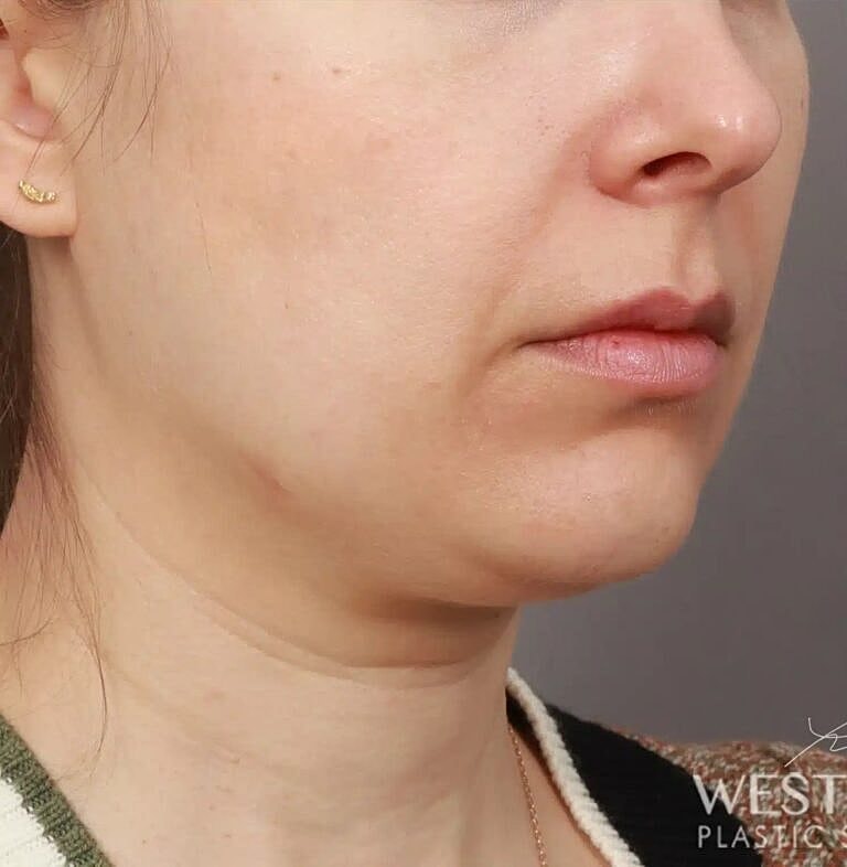 Face Liposuction Before & After