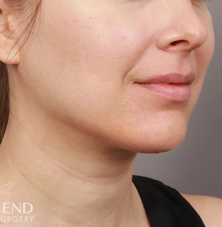 Face Liposuction Before & After