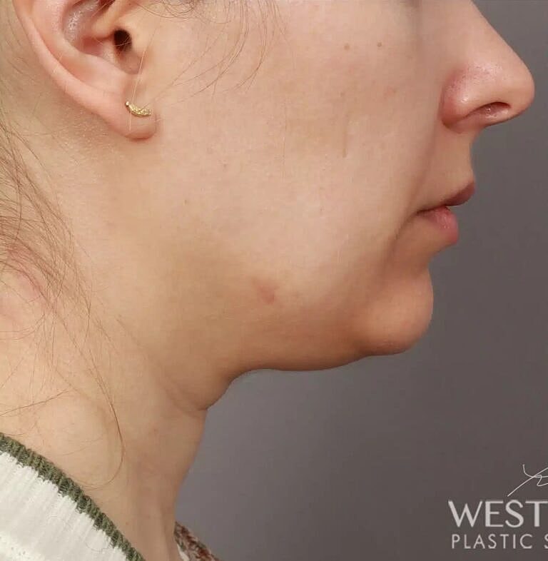 Face Liposuction Before & After