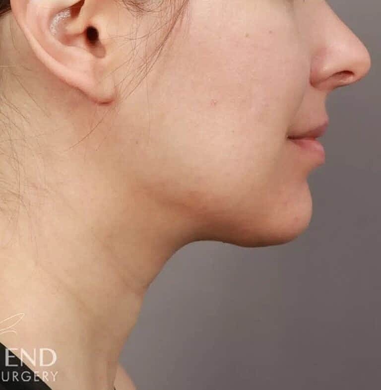 Face Liposuction Before & After