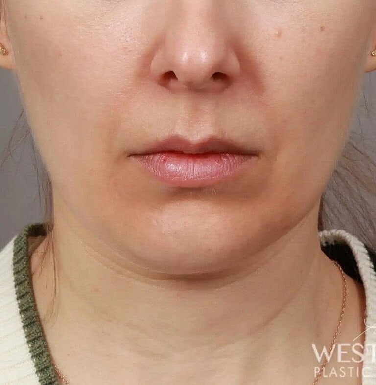 Face Liposuction Before & After