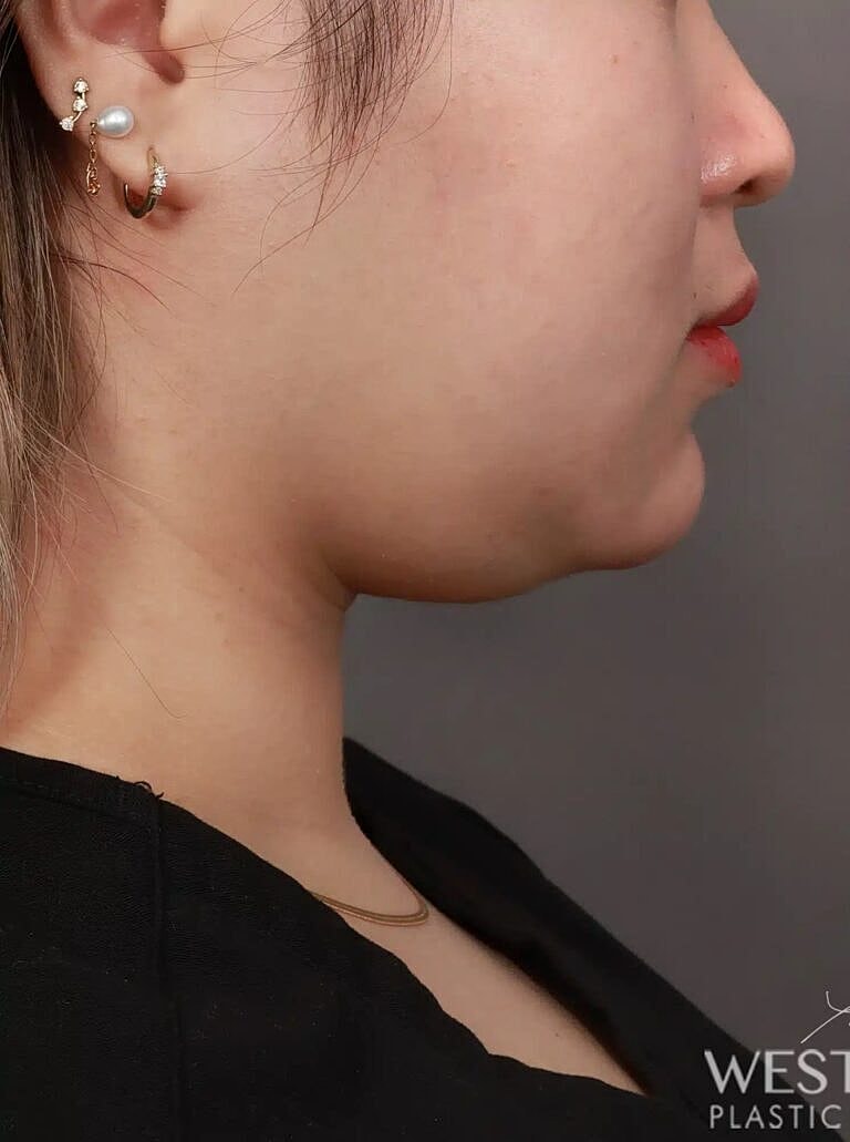 Face Liposuction Before & After