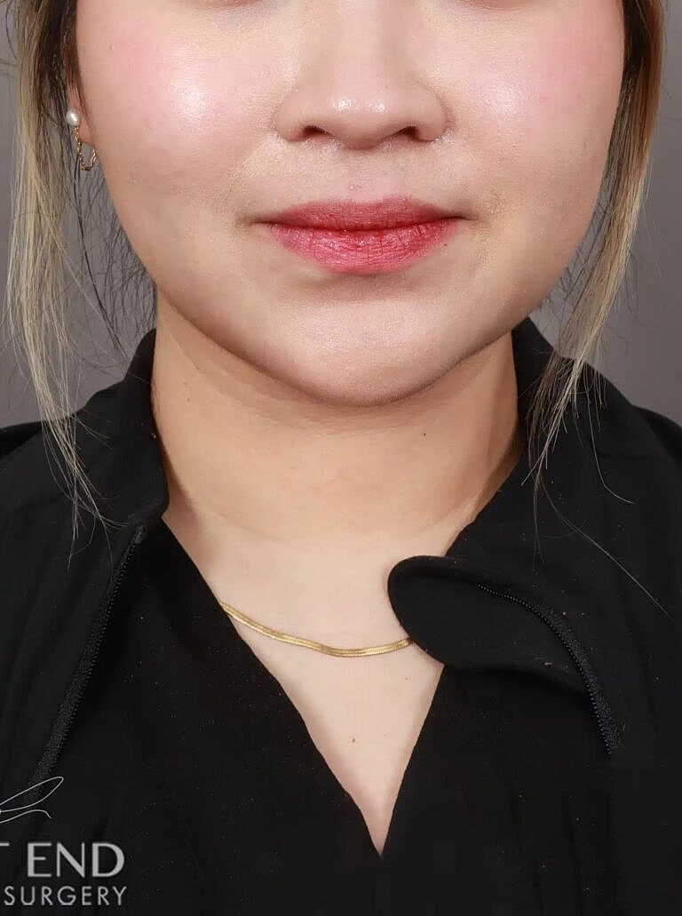 Face Liposuction Before & After