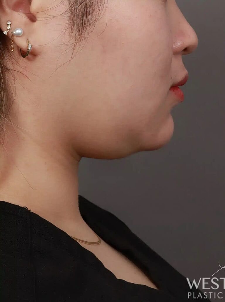 Face Liposuction Before & After
