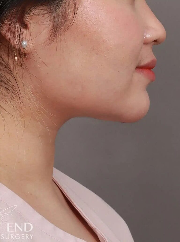 Face Liposuction Before & After