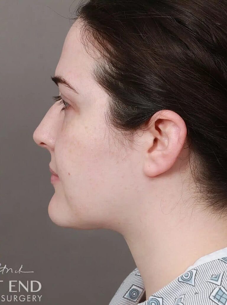 Face Liposuction Before & After