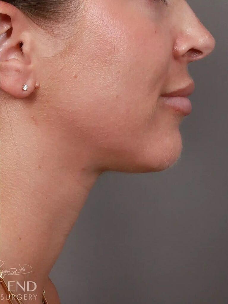 Face Liposuction Before & After