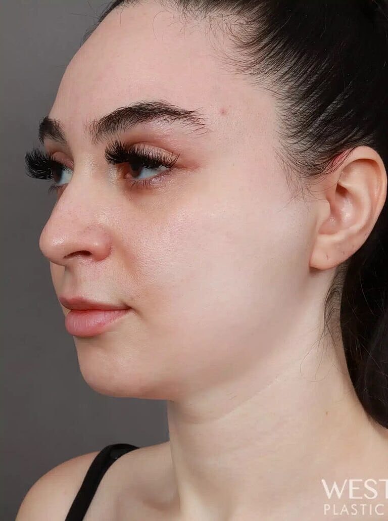 Face Liposuction Before & After