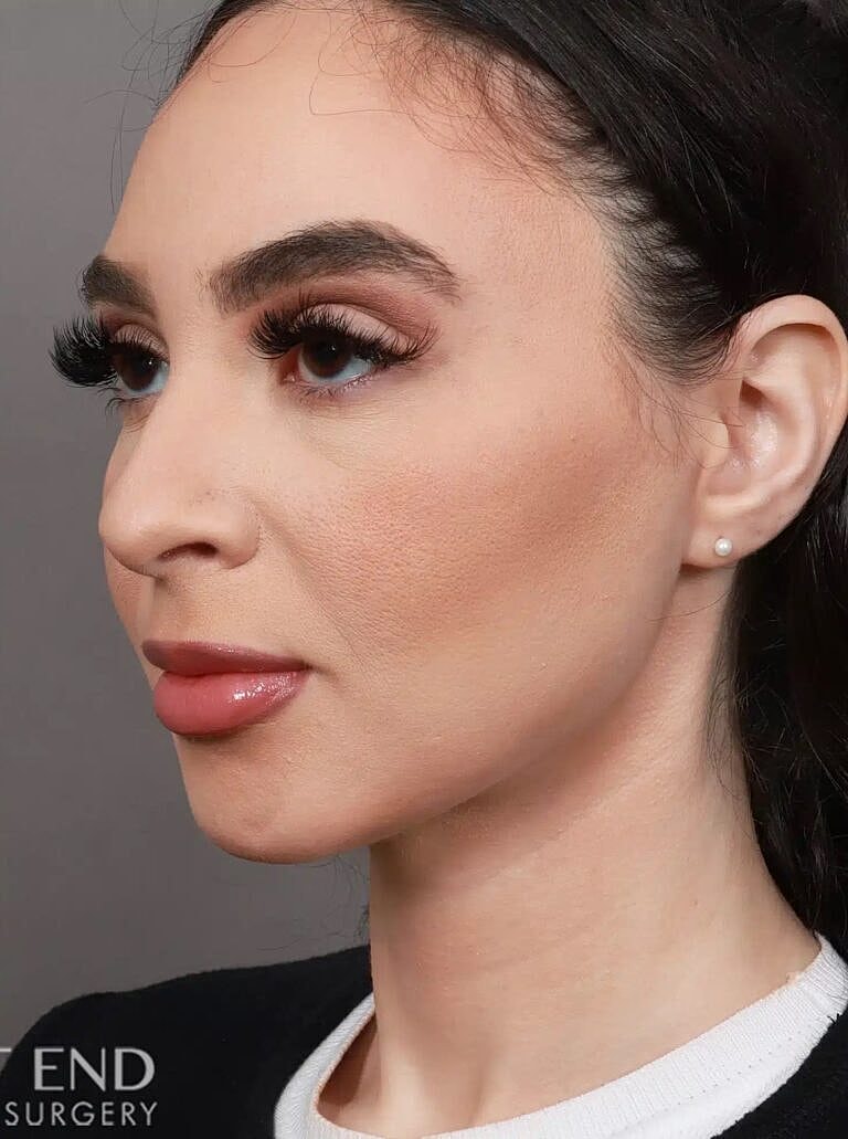 Face Liposuction Before & After