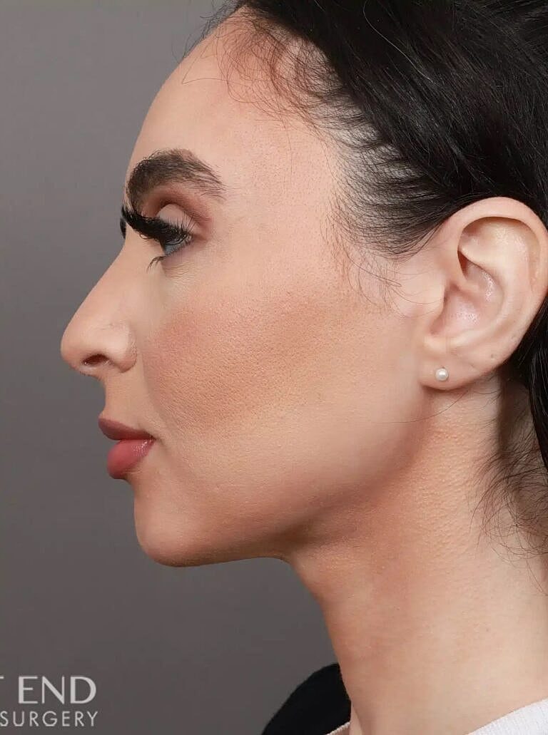 Face Liposuction Before & After