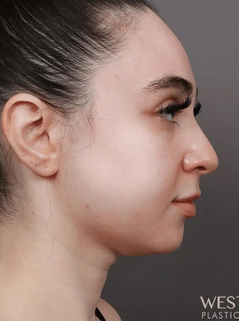 Face Liposuction Before & After