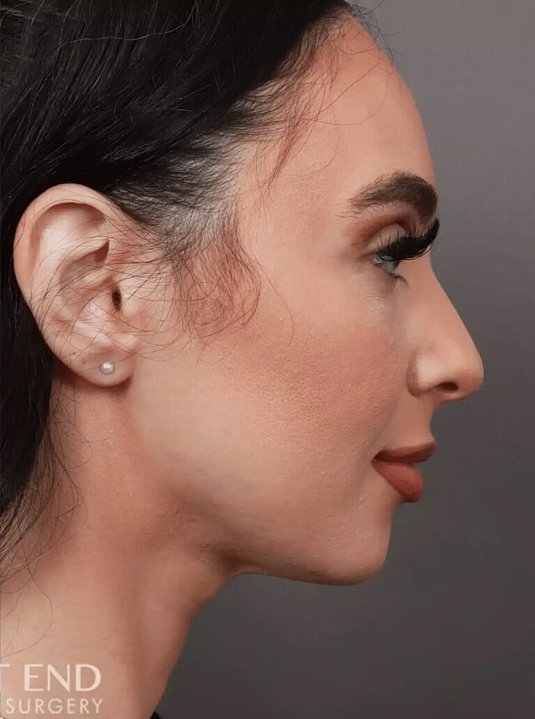 Face Liposuction Before & After