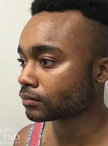 Face Liposuction Before & After