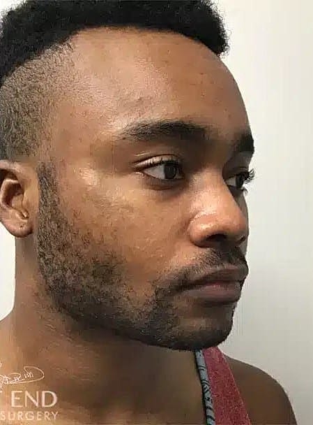 Face Liposuction Before & After