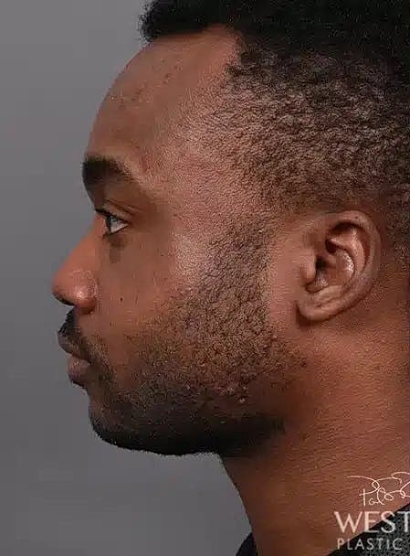 Face Liposuction Before & After