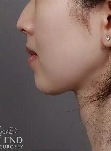 Face Liposuction Before & After