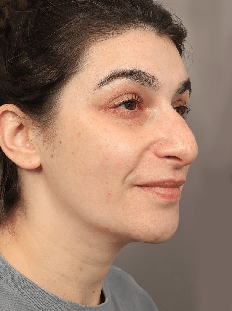 Juvederm Before & After