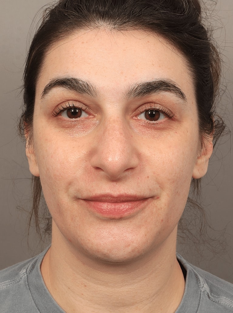 Juvederm Before & After