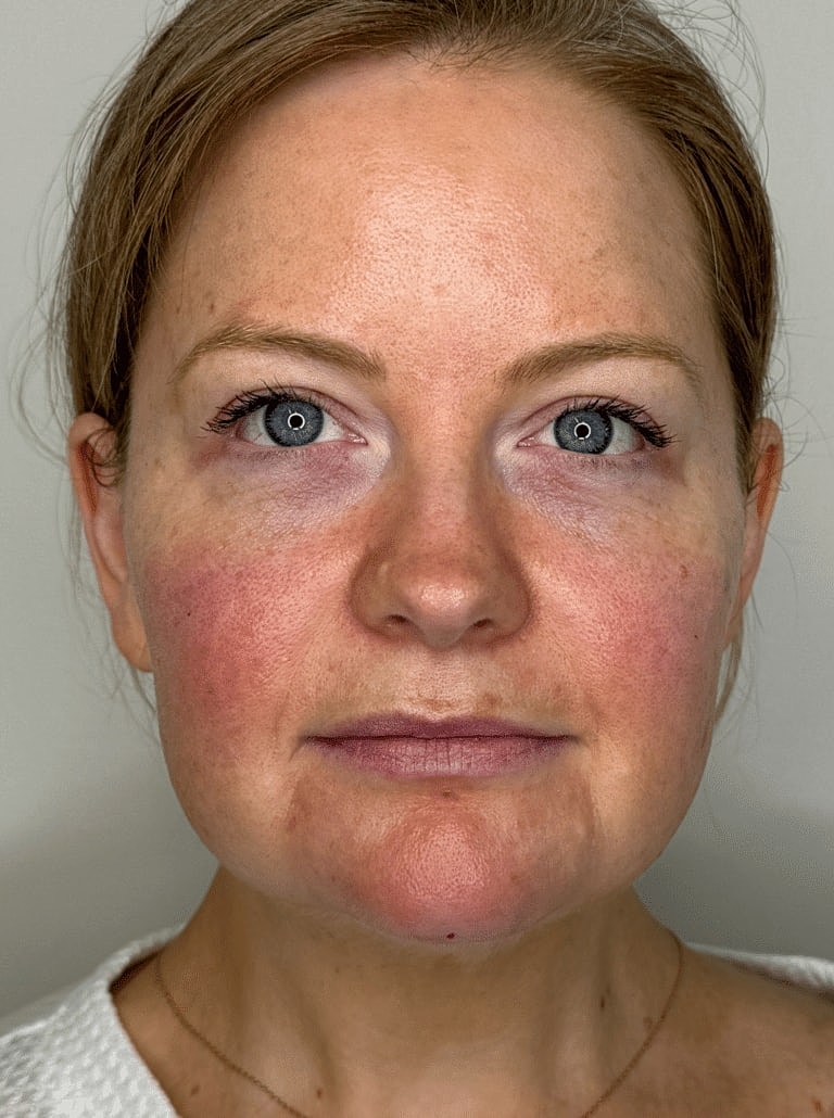 Juvederm Before & After