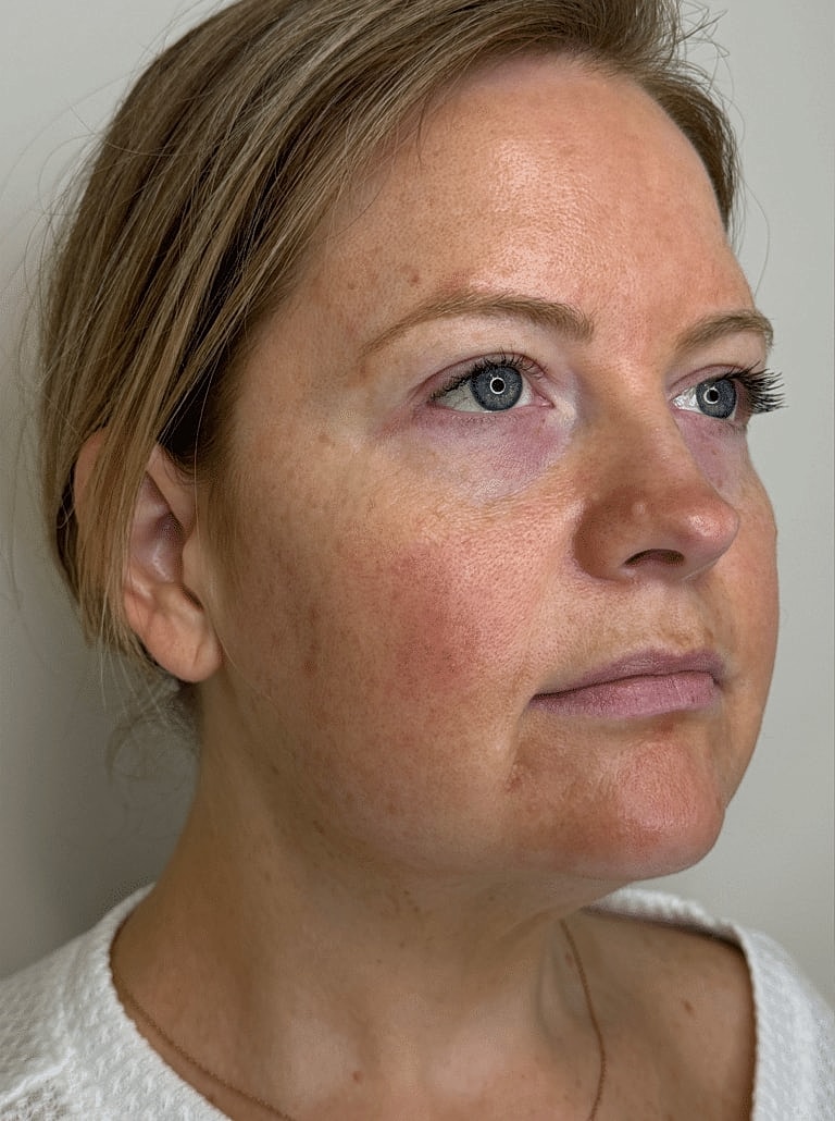 Juvederm Before & After