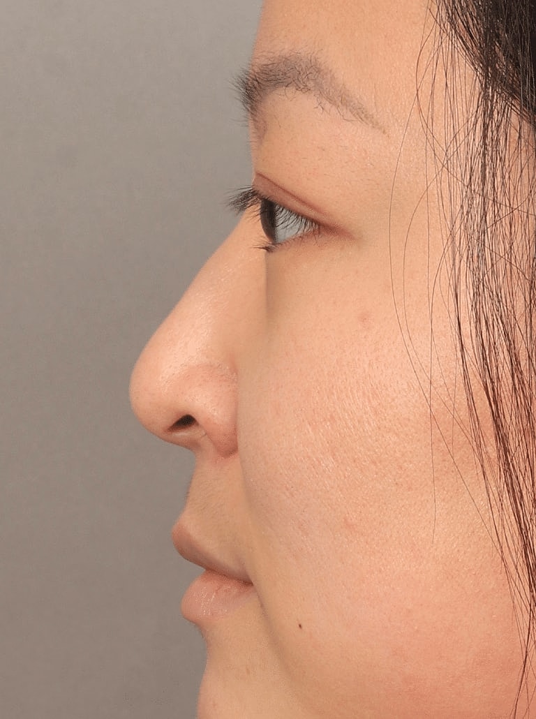 Juvederm Before & After