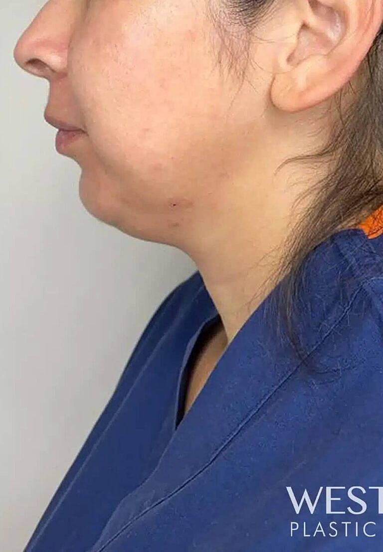 Juvederm Before & After
