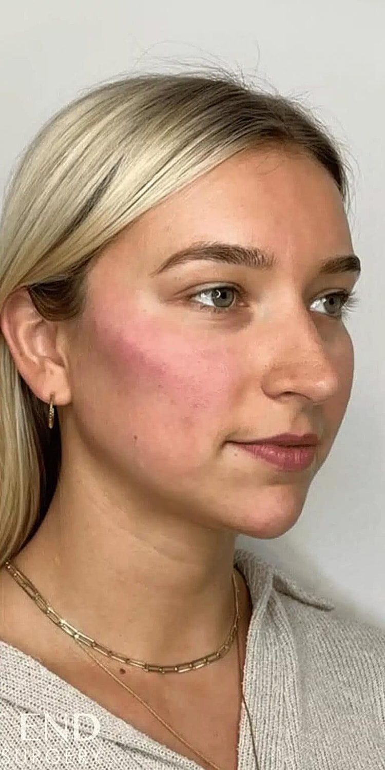 Juvederm Before & After