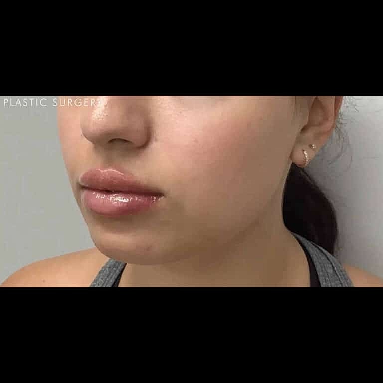 Juvederm Before & After