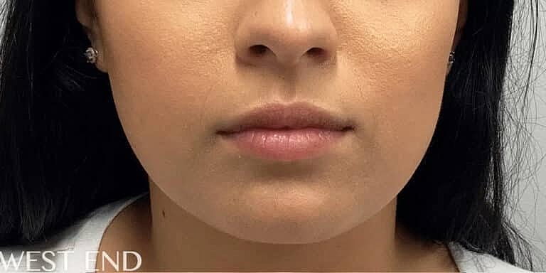 Juvederm Before & After