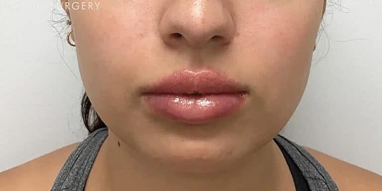 Juvederm Before & After