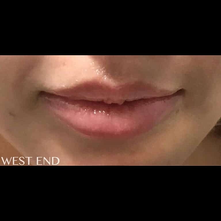 Juvederm Before & After