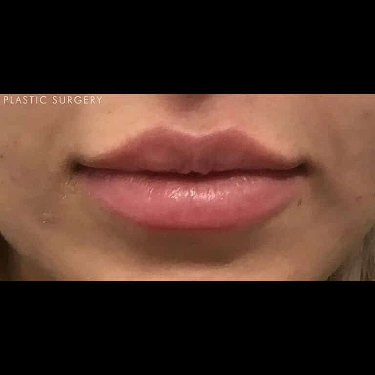 Juvederm Before & After