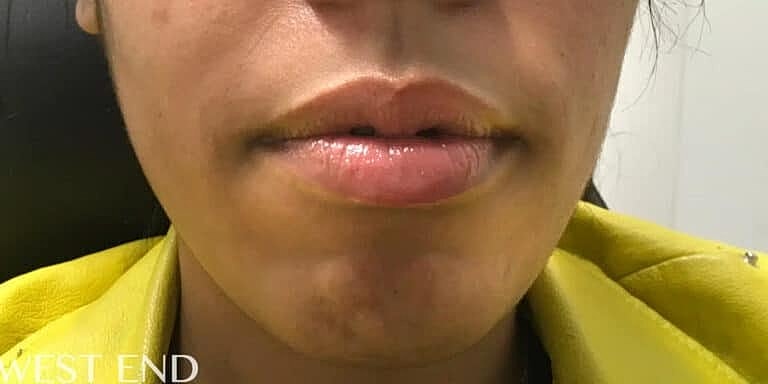 Juvederm Before & After