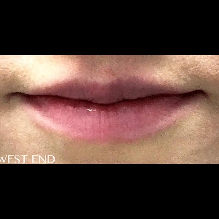 Juvederm Before & After