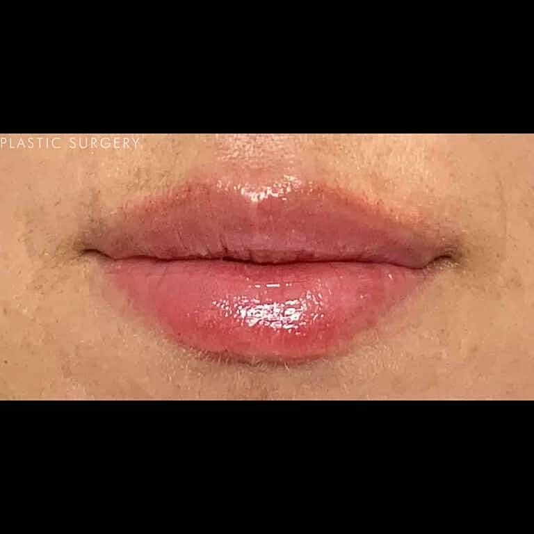 Juvederm Before & After