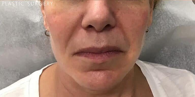 Juvederm Before & After
