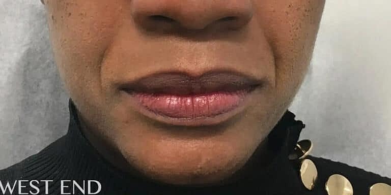 Juvederm Before & After