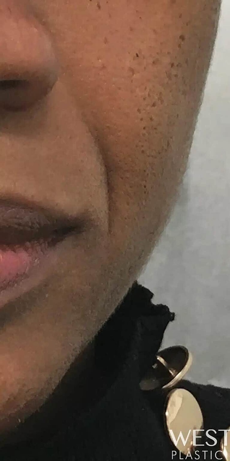 Juvederm Before & After