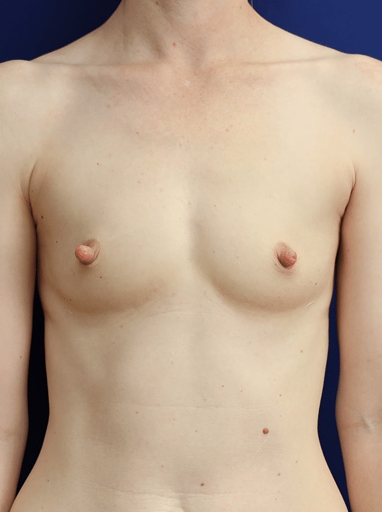 Breast Augmentation Before & After
