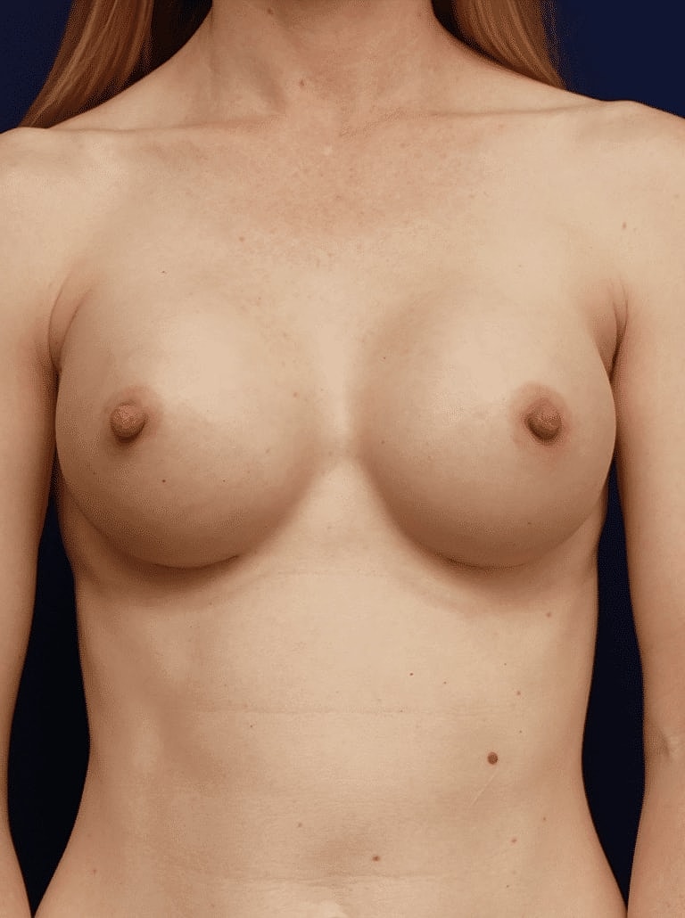 Breast Augmentation Before & After