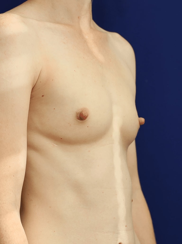 Breast Augmentation Before & After