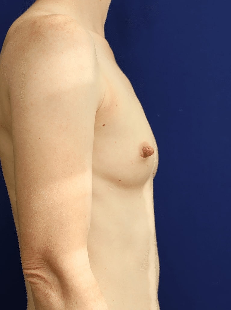 Breast Augmentation Before & After