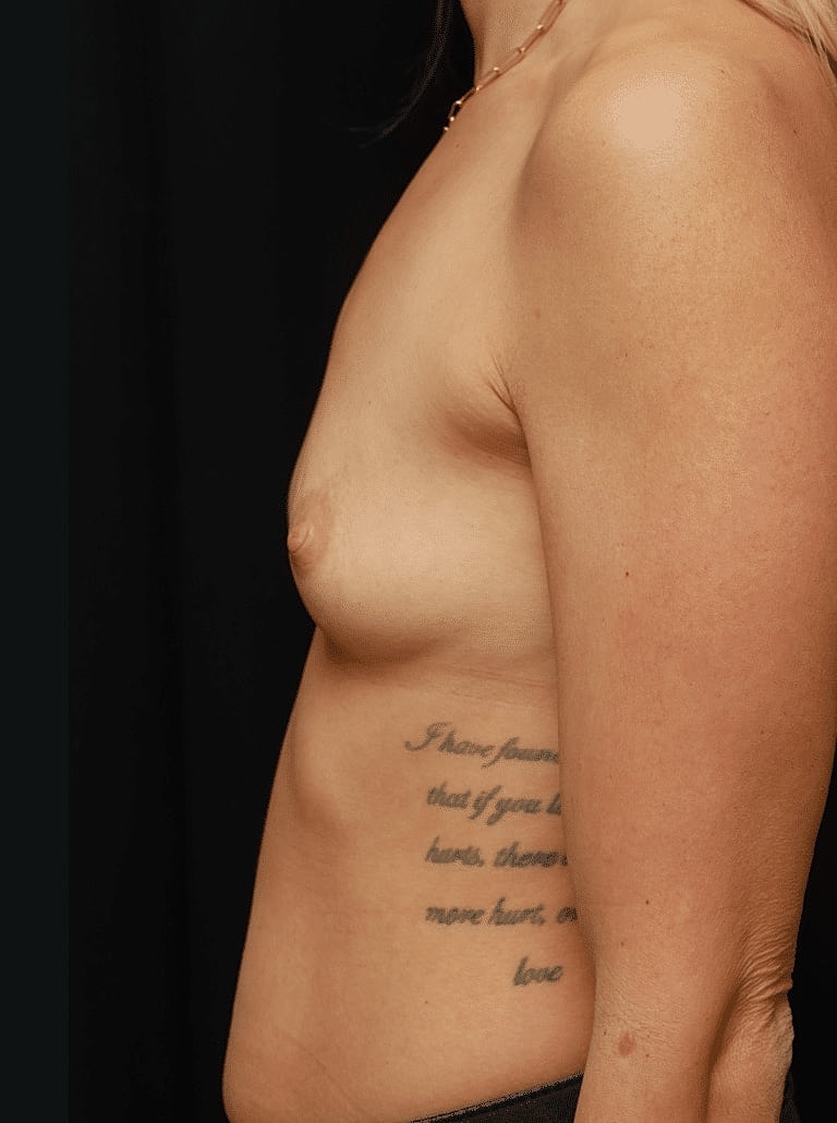 Breast Augmentation Before & After